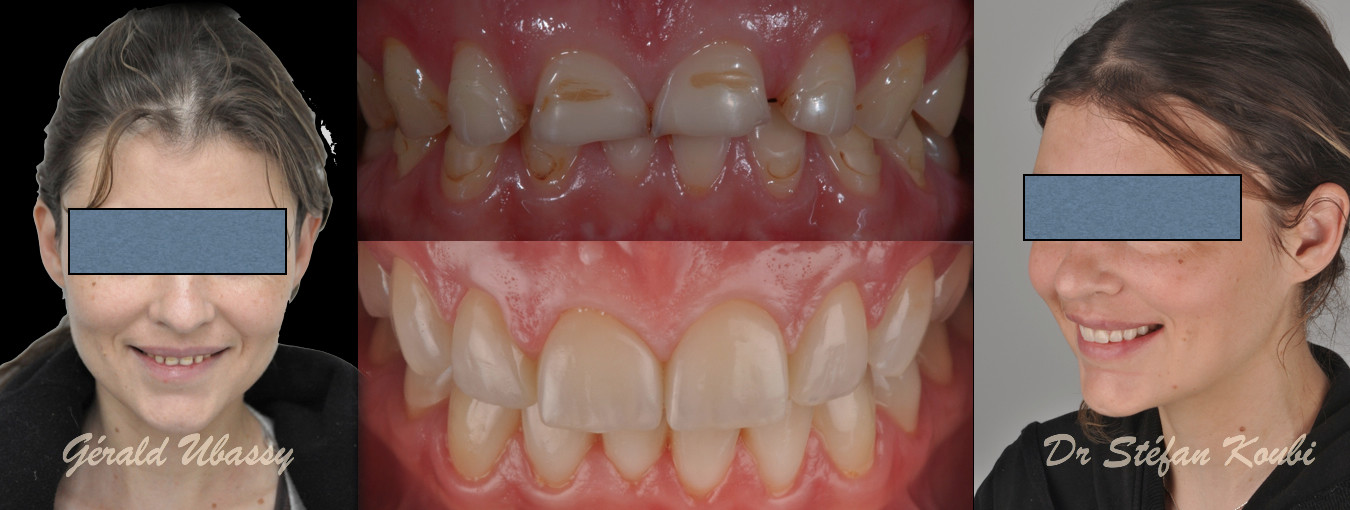 veneers and crowns /Dr Stefan Koubi